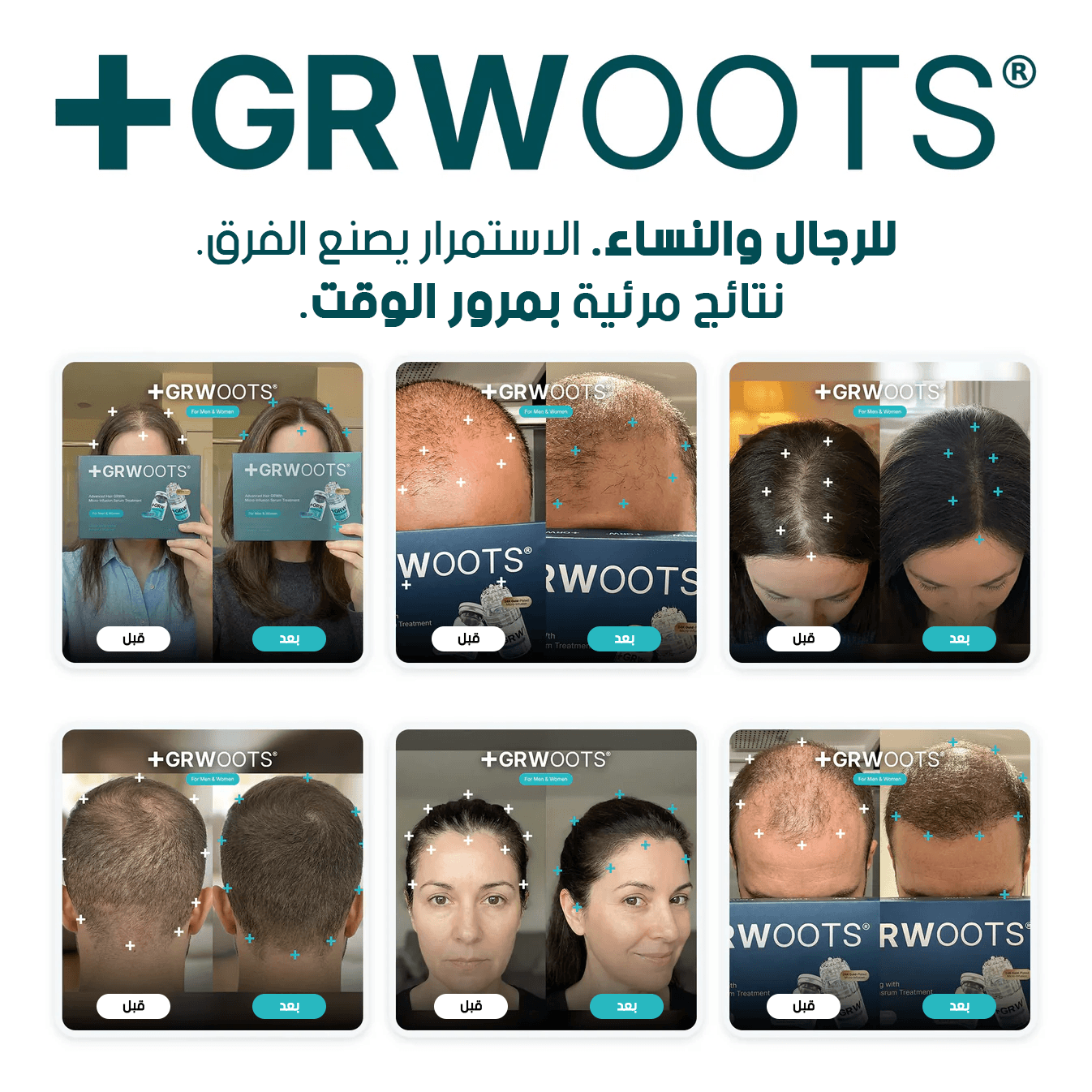 GRWOOTS® علاج بالحقن المجهري لتساقط الشعر ودعم نمو شعر أقوى وأكثر كثافة