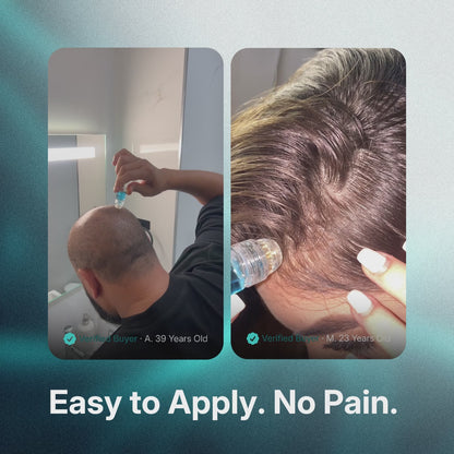 GRWOOTS® Micro-Infusion Hair Growth Treatment